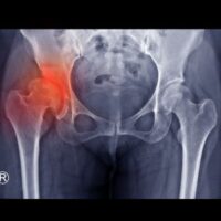 DislocatedHip DislocatedHip