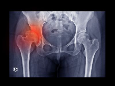 DislocatedHip